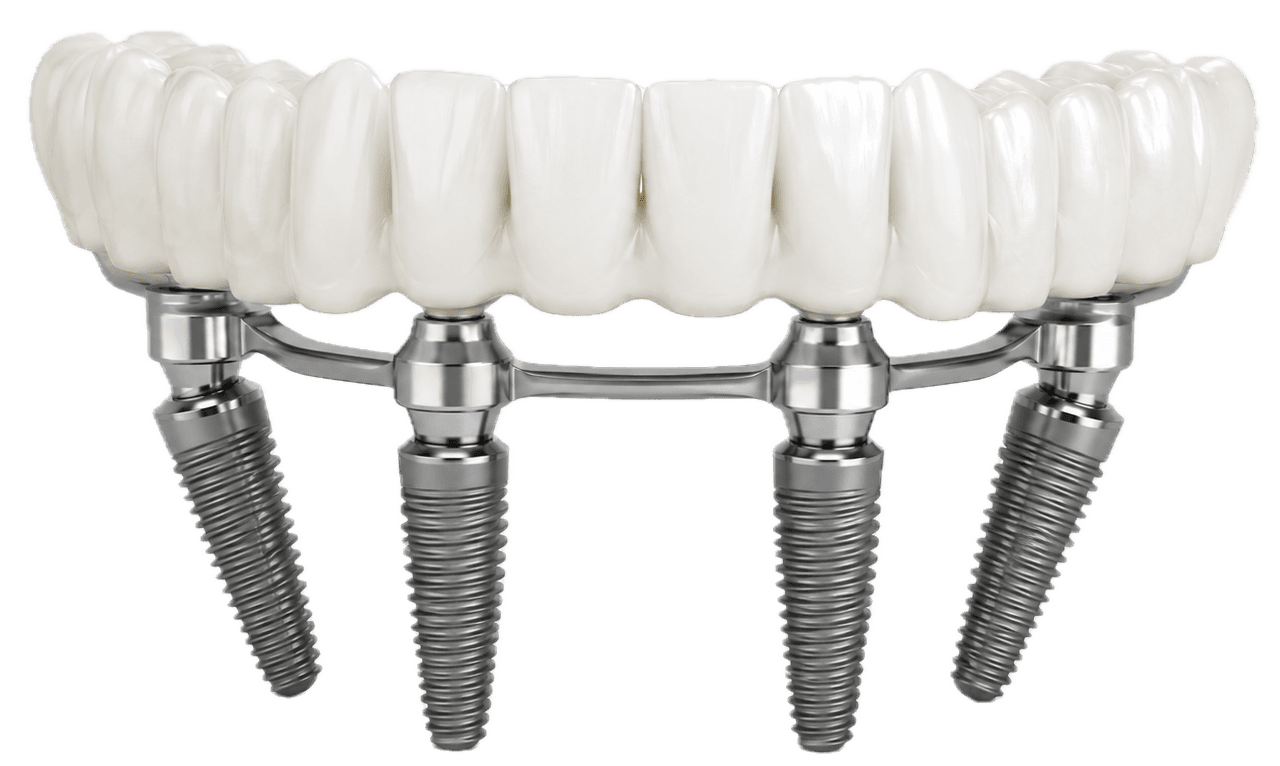 All-on-4 restoration, fixed arch on four implants