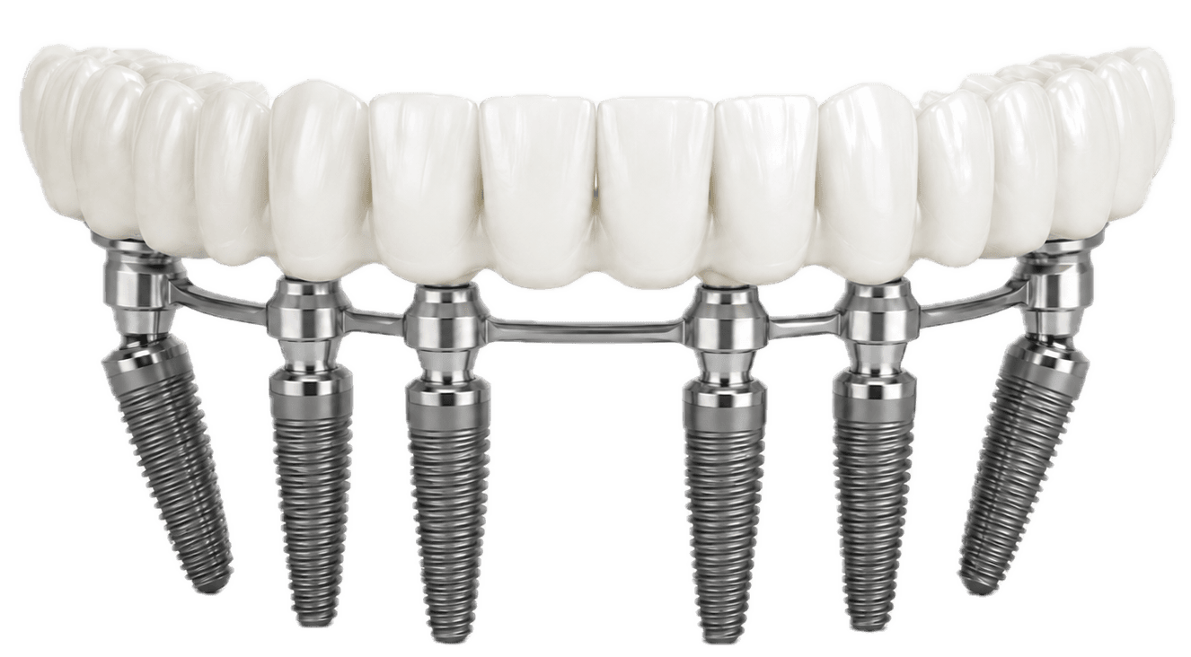 All-on-6 restoration, fixed arch on six implants