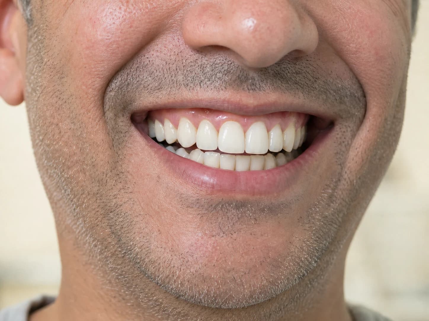 Visual simulation after restoring a missing tooth with an implant