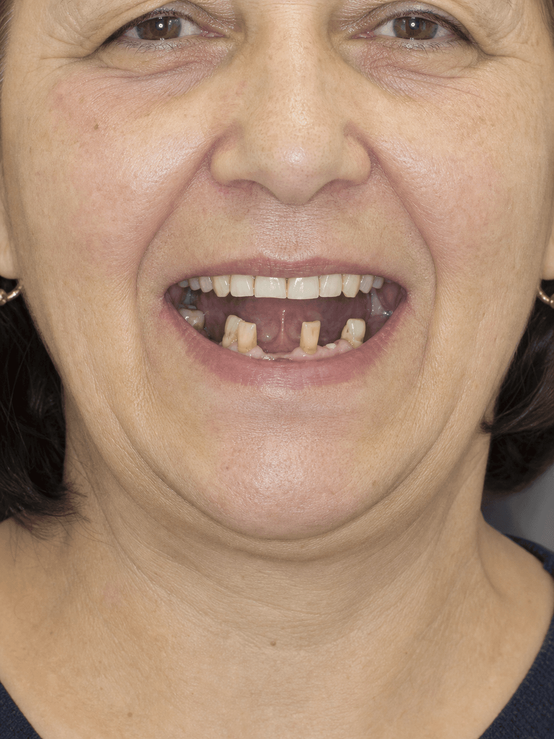 Before All-on-6 treatment