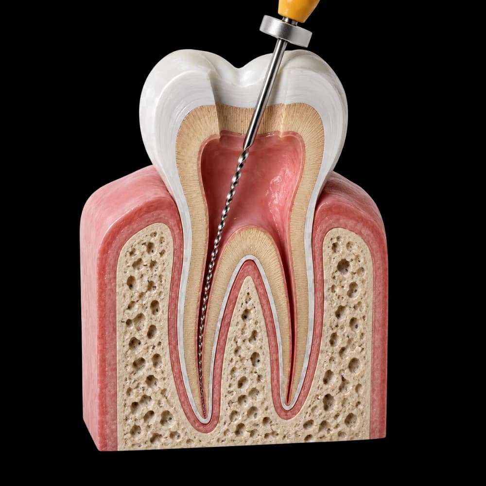 Cross-section of a molar during root canal treatment