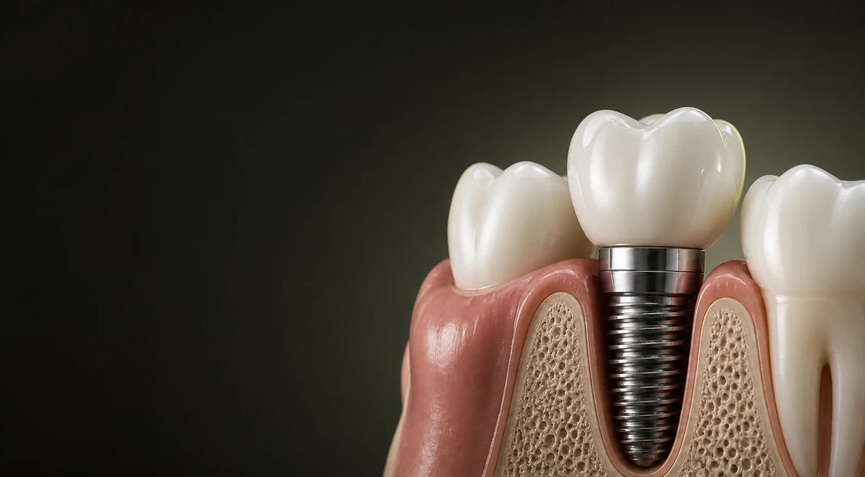 Dental implants, step by step: from consultation to the final crown