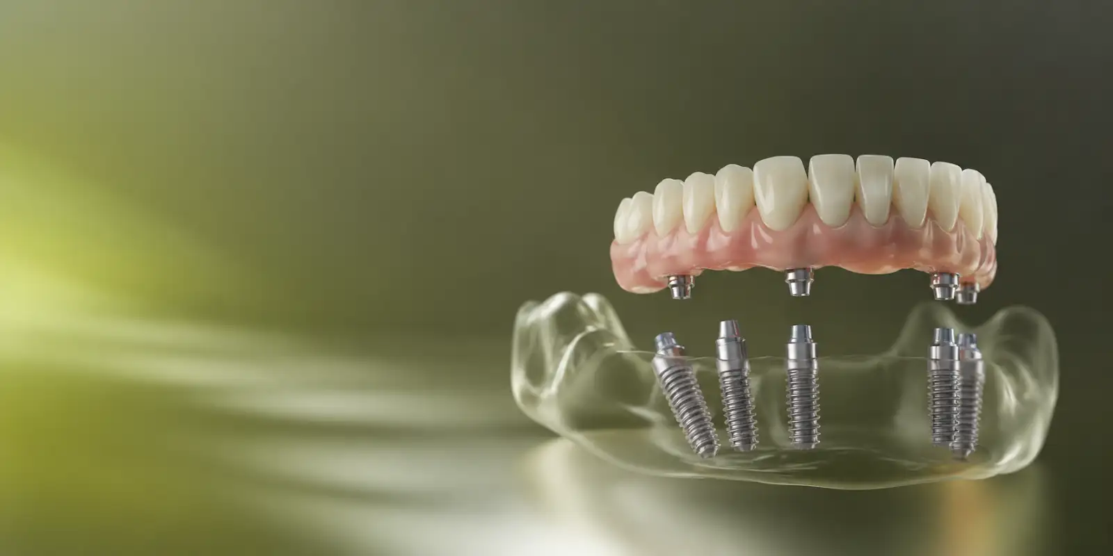 Full-screen photo, the team during an implant procedure